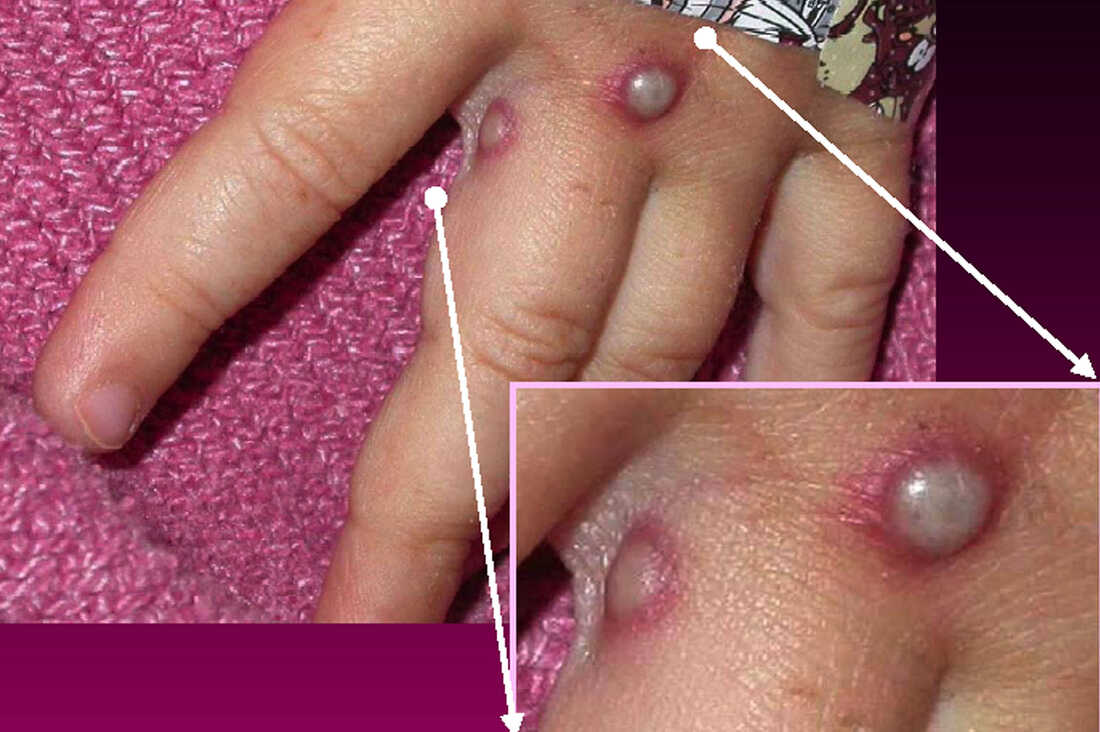 Bỉ cách ly bắt buộc 21 ngày với bệnh nhân mắc bệnh đậu mùa khỉ